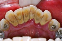 cách hạn chế vôi răng hình thành (1)