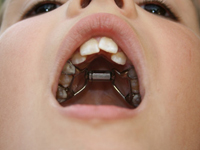 Những lệch lạc răng mặt nào thường gặp nhất, ảnh hưởng đến sức khỏe răng miệng như thế nào?