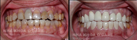 răng nhiễm mầu