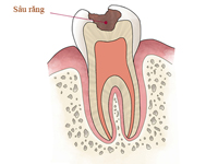 Tìm hiểu về bệnh sâu răng , và các nguy cơ răng miệng do sâu răng gây ra.