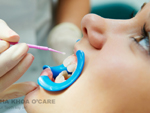 Răng sâu có cần trám, có các phương pháp trám răng nào?