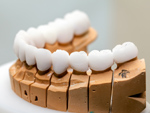 Bọc răng sứ có ưu điểm và nhược điểm gì?