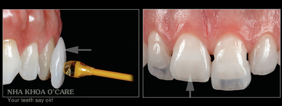mặt dán sứ veneers, khắc phục nhược điểm của bọc răng sứ