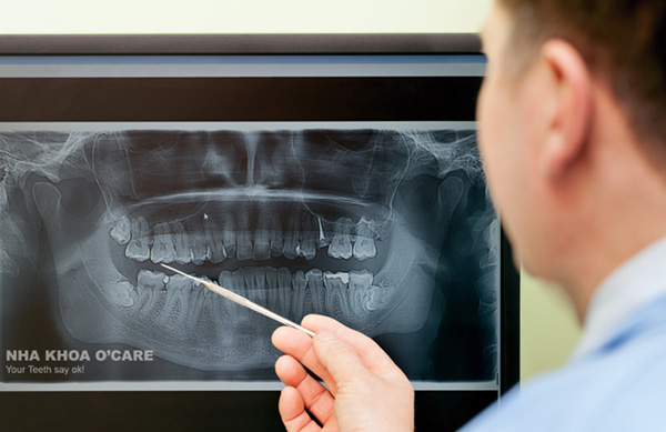 chụp x-quang chẩn đoán đau răng