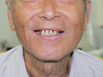 Bệnh nhân 80 tuổi được trồng răng bằng phương pháp cấy ghép implant