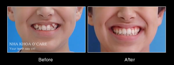 trước và sau niềng răng khểnh 