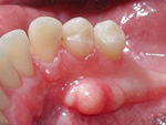 Xương hàm răng nổi cục u lồi là bệnh gì? Có nguy hiểm không?