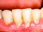 Tìm hiểu về vôi răng, nguyên nhân hàng đầu gây ra các bệnh răng miệng