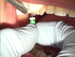 Tại sao phải bọc răng sứ sau khi điều trị tủy răng?