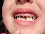 Sâu răng ảnh hưởng đến trẻ như thế nào?