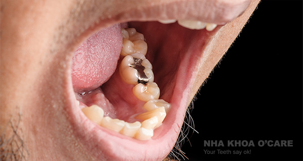 Nói không với thủy ngân trong nha khoa, đặc biệt là trám răng Amalgam