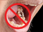 Nói không với thủy ngân trong nha khoa, đặc biệt là trám răng Amalgam