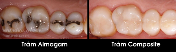 So sánh trám răng Amalgam và trám răng Composite