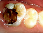 Bệnh nhân răng sâu bị vỡ đôi khi đi khám.