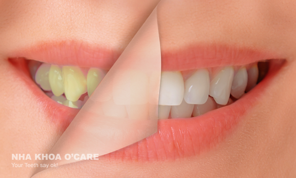 Tìm hiểu nguyên nhân khiến răng bạn vàng ố