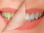 Tìm hiểu nguyên nhân khiến răng bạn vàng ố