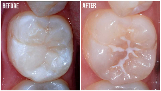 Trám bít các hố rãnh bề mặt răng để ngăn ngừa sâu răng