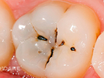 Trám bít các hố rãnh bề mặt răng để ngăn ngừa sâu răng