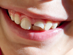 Trẻ bị chấn thương gãy răng phải xử lý như thế nào?