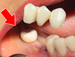 Tại sao làm cầu răng sứ vẫn không ngăn ngừa được tiêu xương hàm?
