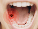 Sâu răng lỗ to gây ra biến chứng gì?