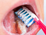 Bệnh viêm lợi - Nguyên nhân gây chảy máu chân răng khi đánh răng