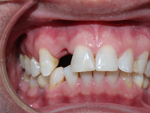Nguy cơ mất răng vĩnh viễn do các bệnh răng miệng sau đây.