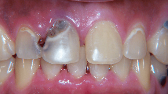 viêm nướu - chân răng bị đen 2