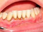 Viền nướu chân răng bị đen - Nguyên nhân và cách xử lý