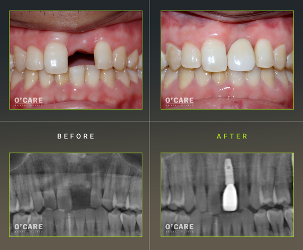 trước và sau khi cấy ghép implant