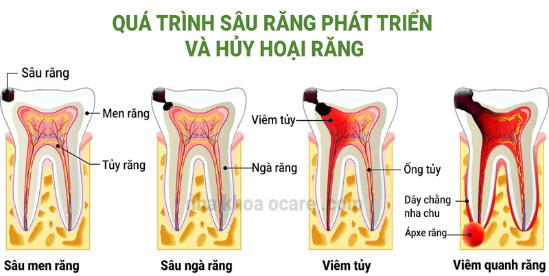 quá trình sâu răng phát triển