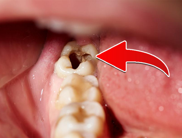 Răng khôn bị sâu có trám được không hay phải nhổ?