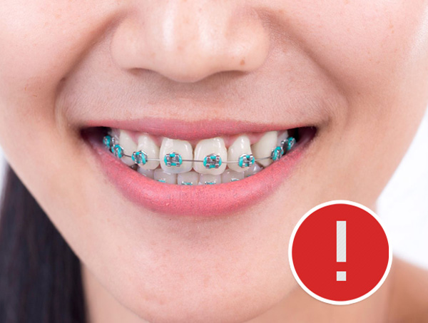 8 nguyên nhân có thể khiến việc niềng răng không thành công