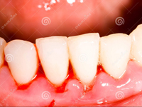 Tại sao đánh răng bị chảy máu răng, nướu sưng và hơi thở có mùi hôi?