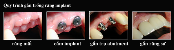 trồng răng giả implant
