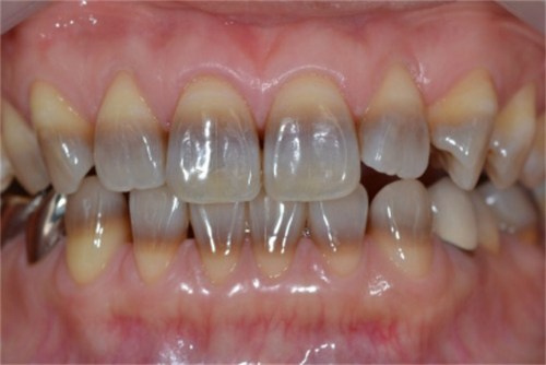 răng nhiễm tetracycline