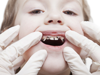 Răng trẻ bị sún có cần phải nhổ không thưa bác sĩ?