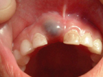 Chân răng nổi cục mủ là bệnh gì?