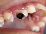 Trẻ bị sún răng có nên nhổ?