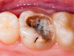 Sâu răng hàm có thể tự nhổ tại nhà không?