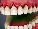 Cao răng có ảnh hưởng gì không?