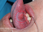 Bị nổi cục thịt ở lưỡi là bệnh gì?