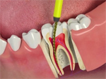 Sau điều trị tủy răng có cần trám lại và bọc sứ không bác sĩ?