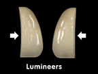 Mặt dán răng sứ Lumineers