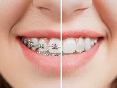 Trước và sau khi niềng răng