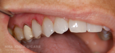 lợi ích trồng răng giả implant02