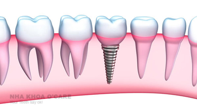 lợi ích trồng răng giả implant