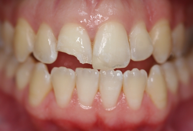 Cách phòng và điều trị nứt, mẻ răng