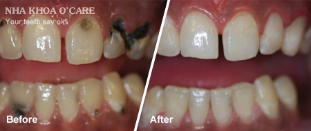 trước và sau trám răng composite 6