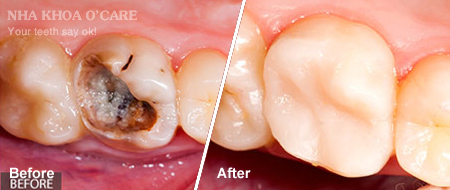 trước và sau trám răng composite 4